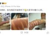 网红“千里寻椰”因光子嫩肤二度烧伤，“火辣辣的痛”持续7小时，医生：获留永久性瘢痕